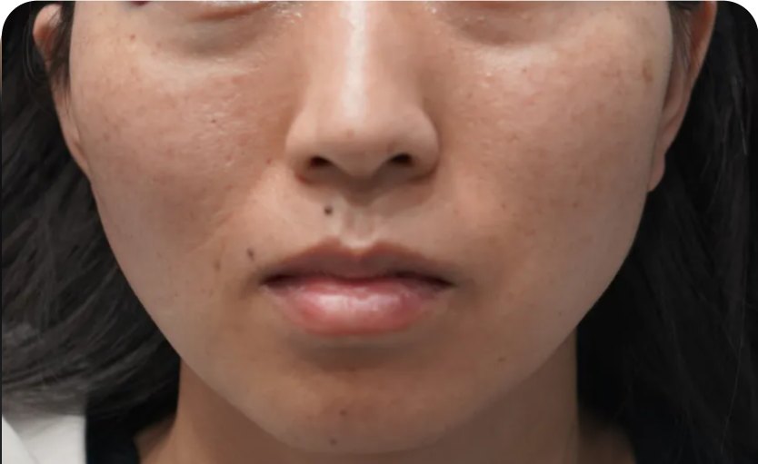 玻尿酸填充:眼下(术前)