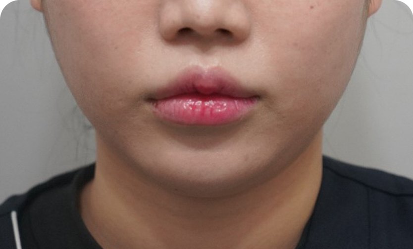 美版超声刀(Ultherapy)500发 + ONDA + 下巴肉毒素 + BELLACHOLINE(术后)