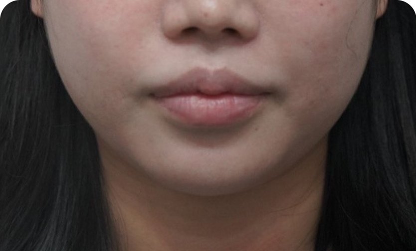 美版超声刀(Ultherapy)500发 + ONDA + 下巴肉毒素 + BELLACHOLINE(术前)