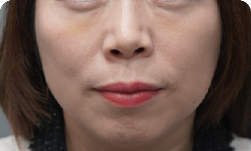Juvelook Volume:眼下(术后)