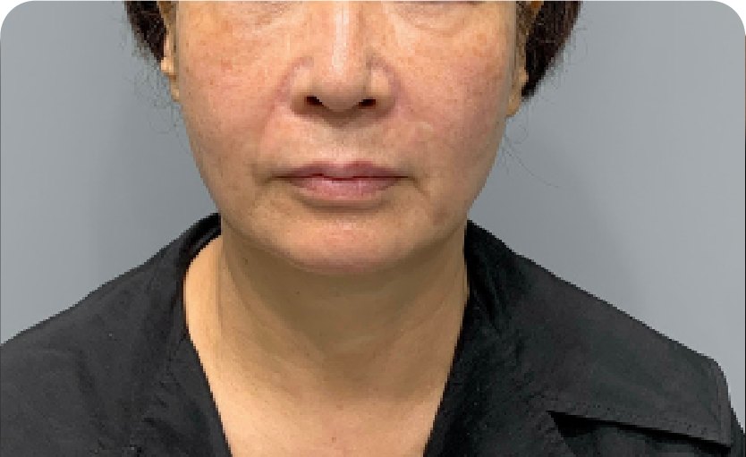 美版超声刀(Ultherapy)600发 + 钛提升(Titanium) + 法令纹填充(术后)