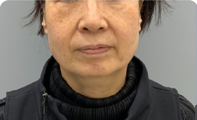 美版超声刀(Ultherapy)600发 + 钛提升(Titanium) + 法令纹填充(术前)