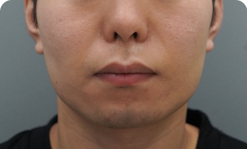 Potenza(微针射频) + 脱毛(术后)