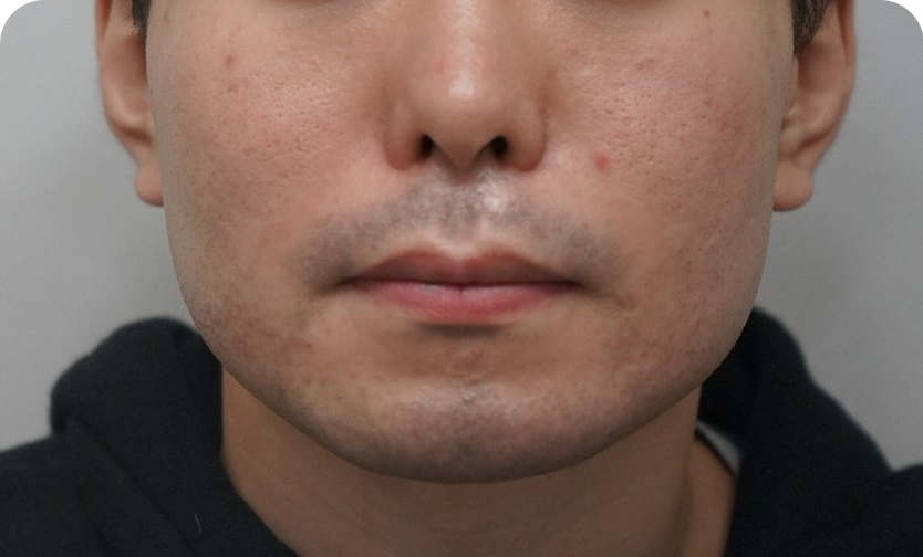 Potenza(微针射频) + 脱毛(术前)